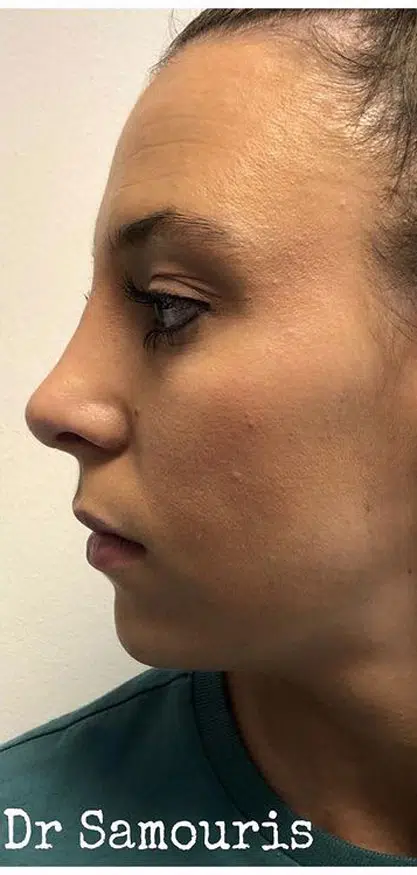 rhinoplastiki-after-7