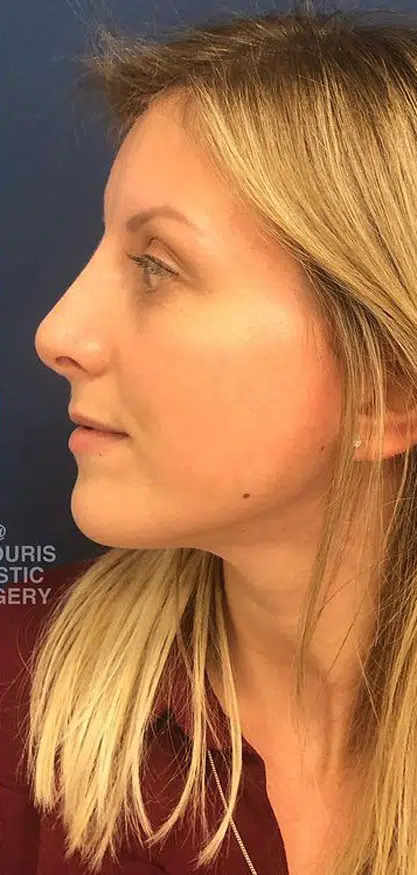 rhinoplastiki-before-6