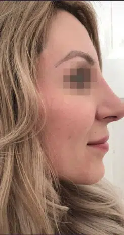 rhinoplasty-after-1