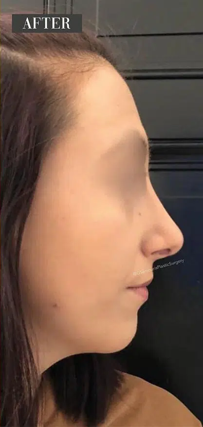 rhinoplasty-after-3