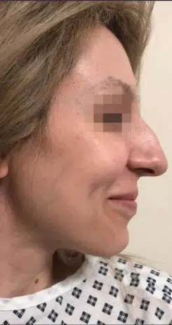 rhinoplasty-before-1