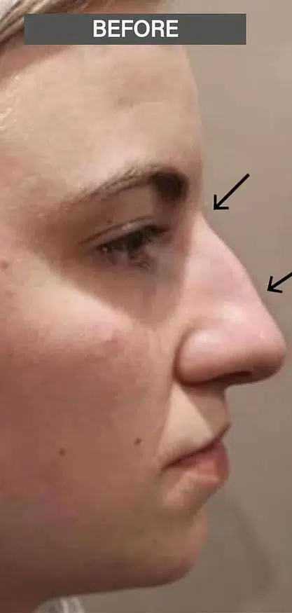 rhinoplasty-before-2