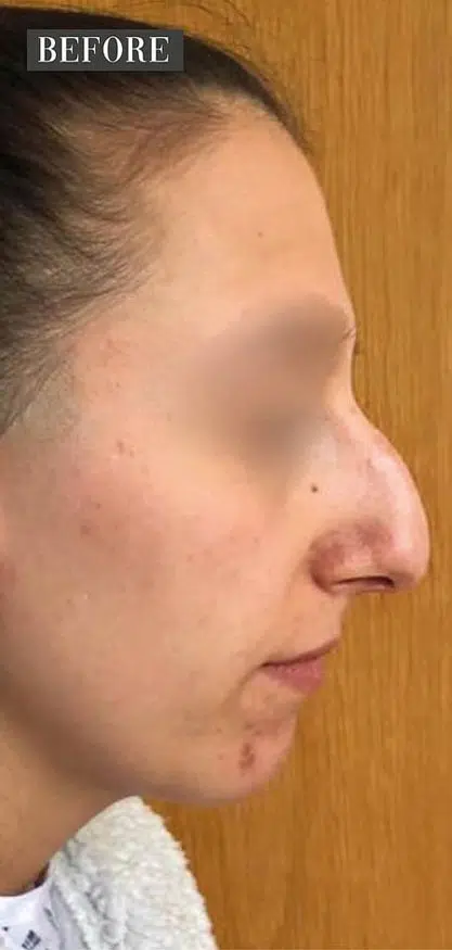 rhinoplasty-before-3